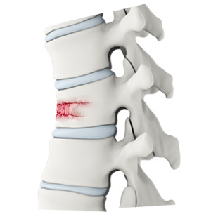 Vertebral Fractures